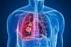 Immunotherapy for lung cancer