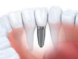 Need to Find Best Dental Implants in New York? There Is an App for That